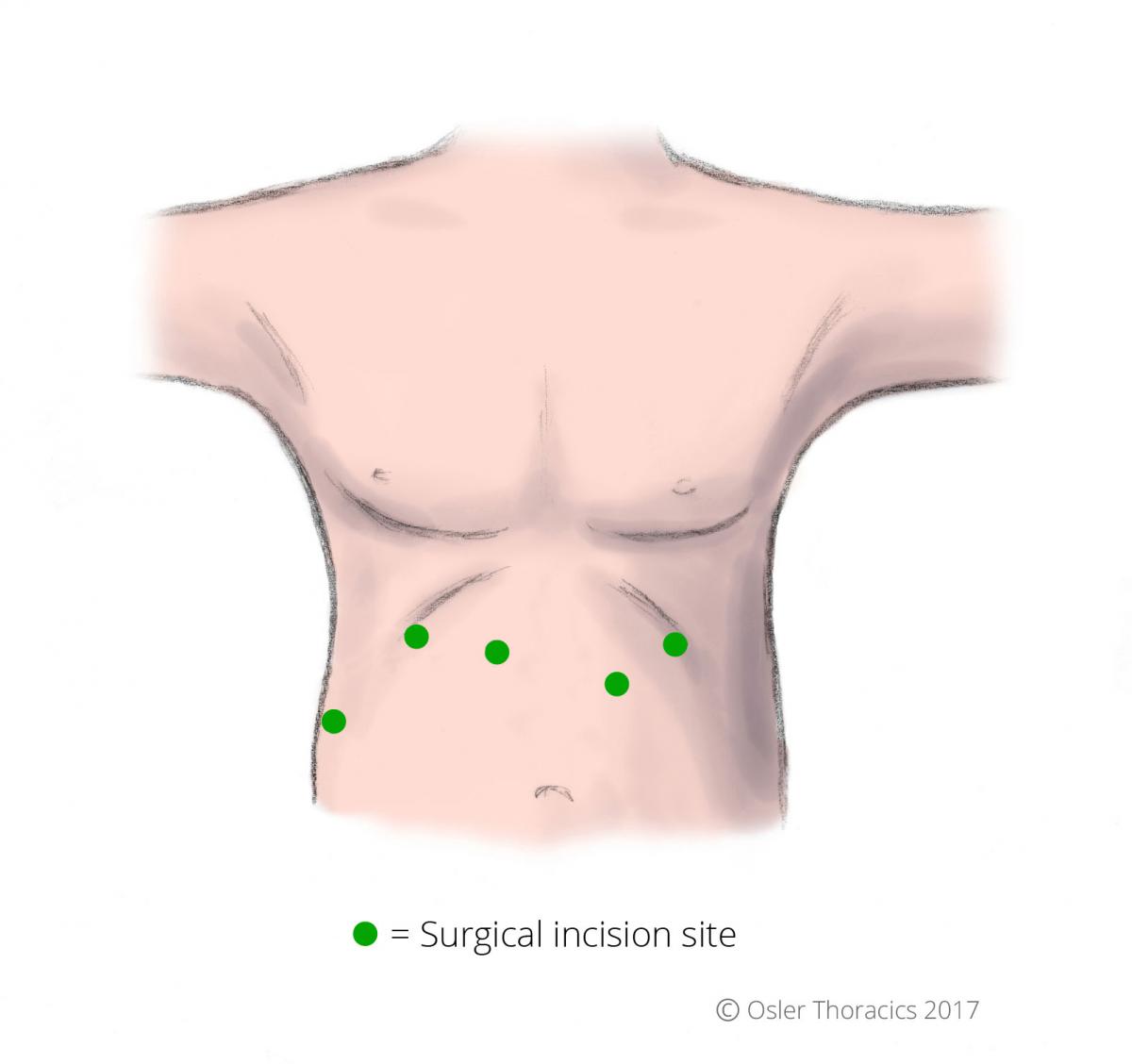 hiatal-hernia-repair-surgery-in-katy-tx-dr-clay-albrecht